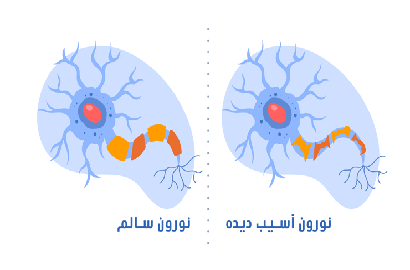 کلینیک فیزیوتراپی و توانبخشی رادان - اسکلروز جانبی آمیوتروفیک