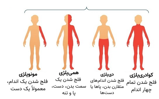 کلینیک فیزیوتراپی و توانبخشی رادان - فلج مغزی