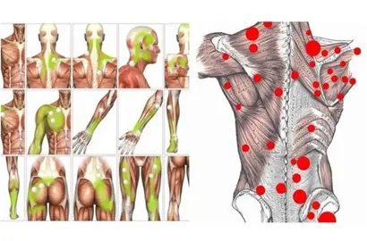 کلینیک فیزیوتراپی و توانبخشی رادان - نقاطه ماشه ای