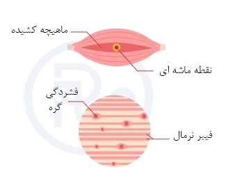 کلینیک فیزیوتراپی و توانبخشی رادان - نقاطه ماشه ای