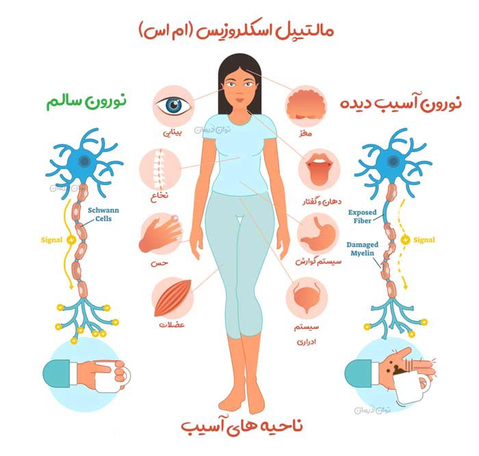 کلینیک فیزیوتراپی و توانبخشی رادان - ام اس (MS)