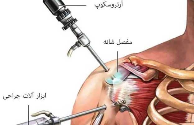 کلینیک فیزیوتراپی و توانبخشی رادان - آرتروسکوپی