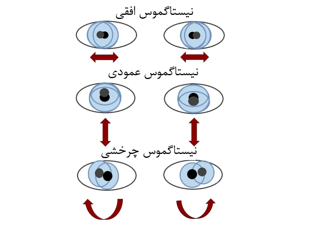 کلینیک فیزیوتراپی و توانبخشی رادان - نیستاگموس