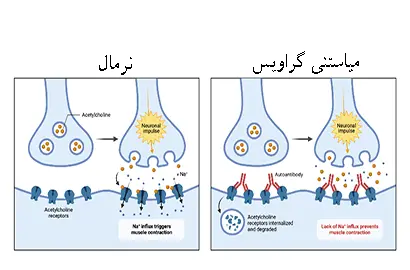 کلینیک فیزیوتراپی و توانبخشی رادان - میاستنی گراویس