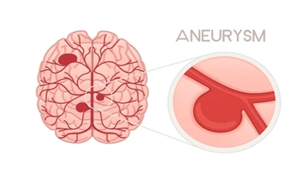 کلینیک فیزیوتراپی و توانبخشی رادان - آنوریسم داخل جمجمه ای