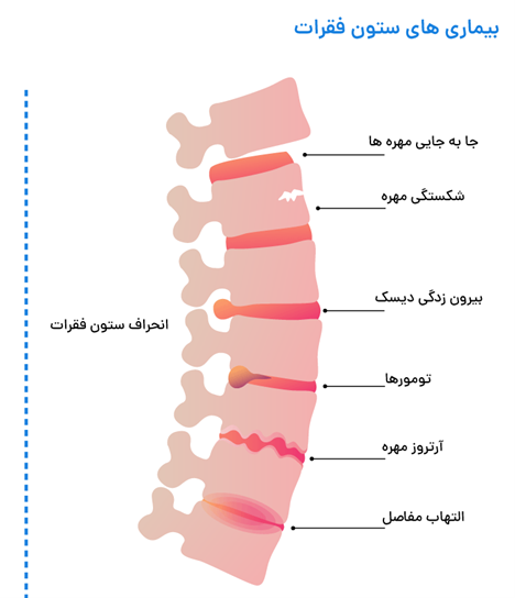 کلینیک فیزیوتراپی و توانبخشی رادان - آسیب های ستون فقرات