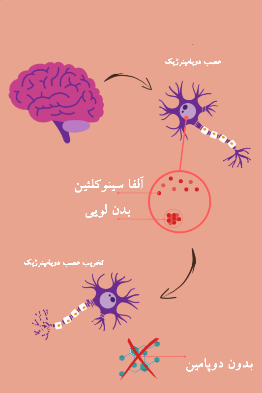 کلینیک فیزیوتراپی و توانبخشی رادان - پارکینسون