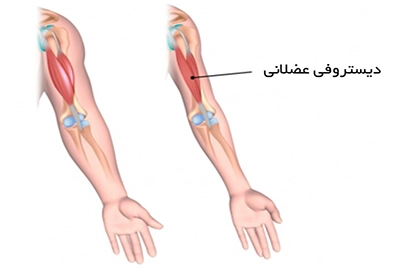 کلینیک فیزیوتراپی و توانبخشی رادان - دیستروفی عضلانی