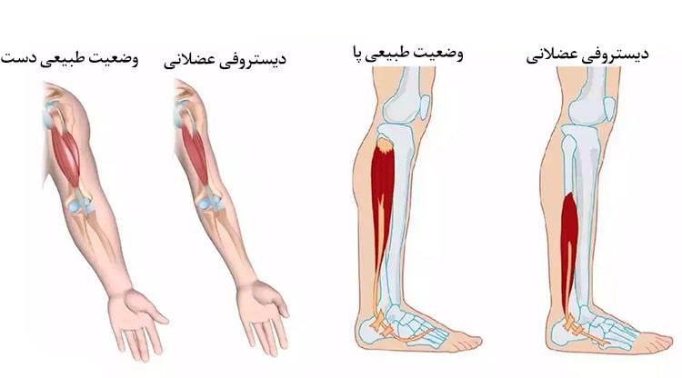 کلینیک فیزیوتراپی و توانبخشی رادان - دیستروفی عضلانی