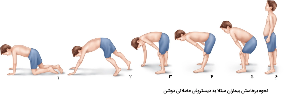 کلینیک فیزیوتراپی و توانبخشی رادان - دیستروفی عضلانی