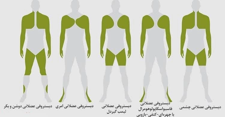 کلینیک فیزیوتراپی و توانبخشی رادان - دیستروفی عضلانی