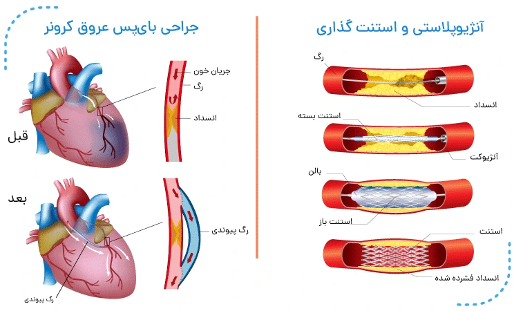 کلینیک فیزیوتراپی و توانبخشی رادان - سکته قلبی