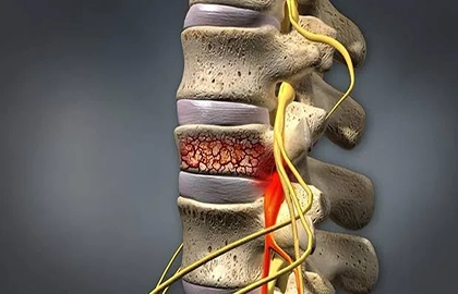 دیسکوپاتی ستون فقرات - کلینیک فیزیوتراپی و توانبخشی رادان