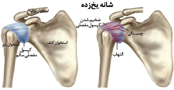 شانه یخ زده - کلینیک فیزیوتراپی و توانبخشی رادان