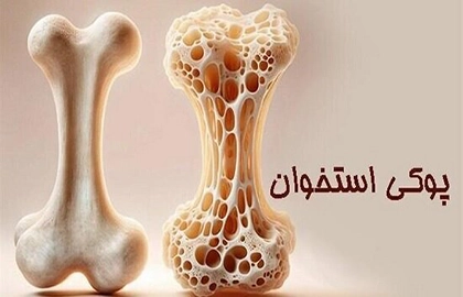 پوکی استخوان - کلینیک فیزیوتراپی و توانبخشی رادان