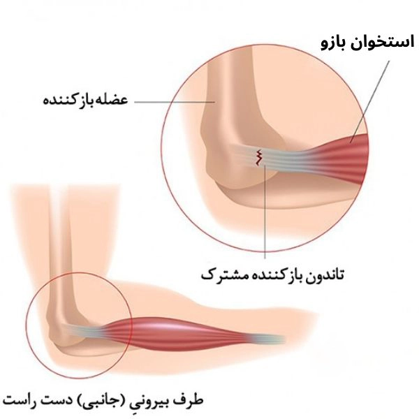 آرنج تنیس - کلینیک فیزیوتراپی و توانبخشی رادان