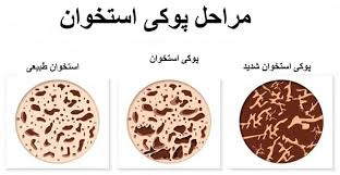 پوکی استخوان - کلینیک فیزیوتراپی و توانبخشی رادان