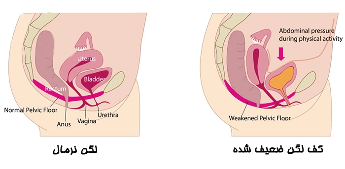 اختلالات کف لگن - کلینیک فیزیوتراپی و توانبخشی رادان