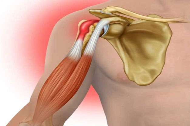 تاندینوپاتی بای سپس - کلینیک فیزیوتراپی و توانبخشی رادان