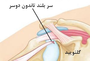 پارگی بای سپس - کلینیک فیزیوتراپی و توانبخشی رادان