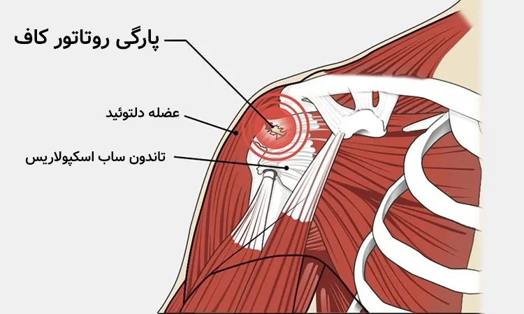 پارگی روتاتورکاف - کلینیک فیزیوتراپی و توانبخشی رادان