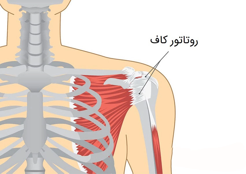 پارگی روتاتورکاف - کلینیک فیزیوتراپی و توانبخشی رادان