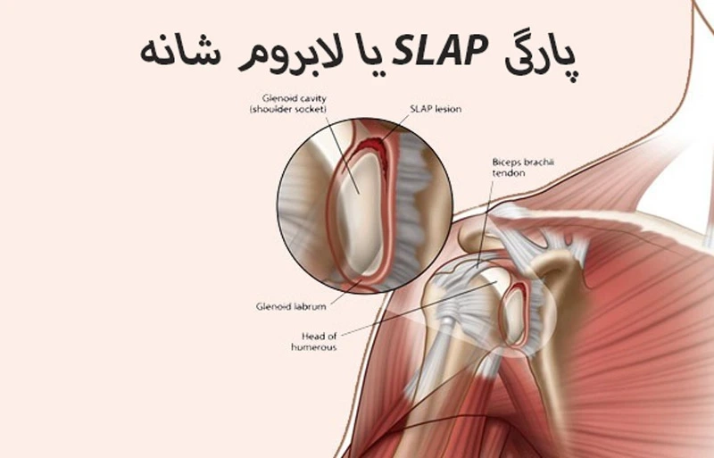 پارگی لابروم شانه - کلینیک فیزیوتراپی و توانبخشی رادان