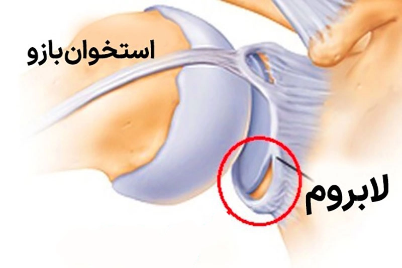 پارگی لابروم شانه - کلینیک فیزیوتراپی و توانبخشی رادان