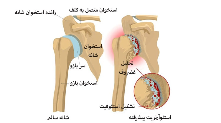 آرتروز شانه - کلینیک فیزیوتراپی و توانبخشی رادان