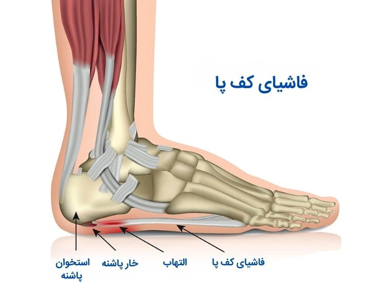 فاشئیت کف پا - کلینیک فیزیوتراپی و توانبخشی رادان