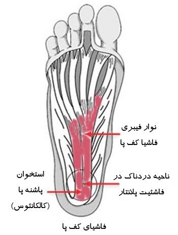 فاشئیت کف پا - کلینیک فیزیوتراپی و توانبخشی رادان