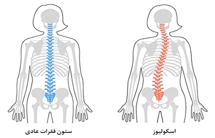 اسکولیوز - کلینیک فیزیوتراپی و توانبخشی رادان