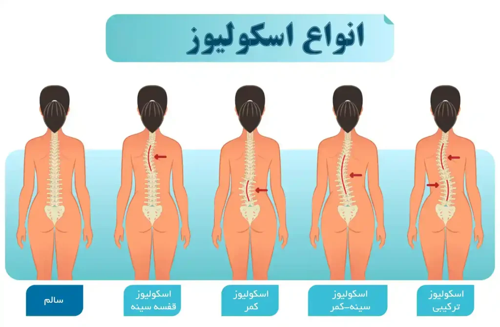 اسکولیوز - کلینیک فیزیوتراپی و توانبخشی رادان