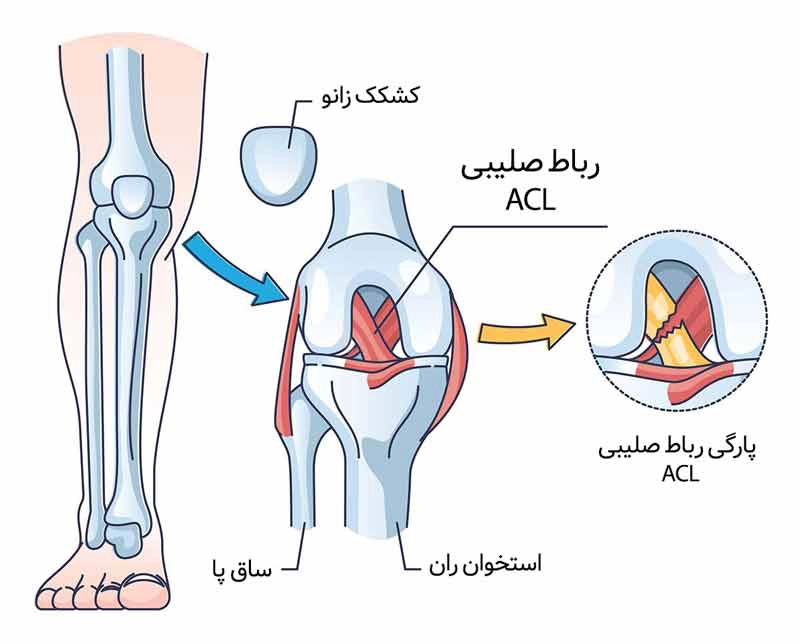 رباط صلیبی قدامی - کلینیک فیزیوتراپی و توانبخشی رادان
