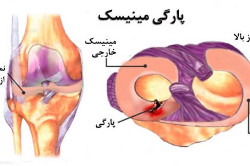 آسیب مینیسک - کلینیک فیزیوتراپی و توانبخشی رادان
