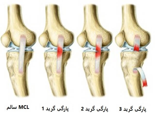آسیب لیگامان کلترال - کلینیک فیزیوتراپی و توانبخشی رادان