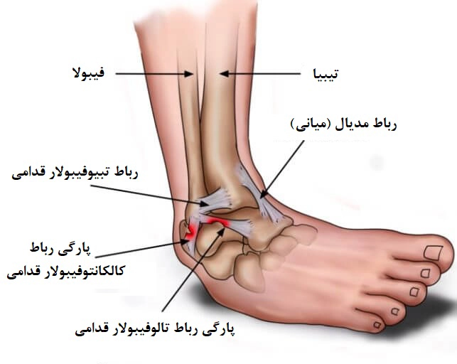 پیچ خوردگی مچ پا - کلینیک فیزیوتراپی و توانبخشی رادان