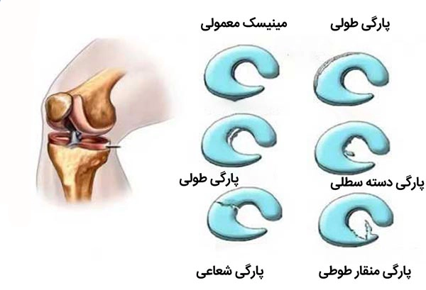 آسیب مینیسک - کلینیک فیزیوتراپی و توانبخشی رادان